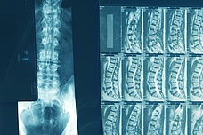 koehler neurosurgery treatments vertebrae